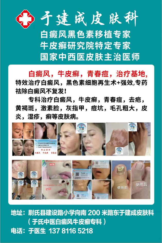 于‬氏祖传中医白癜风专‬‎科，专科治疗白癜风，牛皮癣，青春痘，疤痕，黄褐斑，激素脸等各种皮肤病